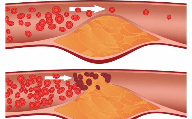 Tắc nghẽn mạch máu là gì? Bệnh lý nguy hiểm