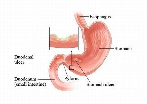 Thủng dạ dày tá tràng do viêm loét niêm mạc nặng hoặc do những sẹo non, sẹo già trên thành ruột.