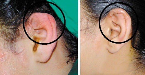 Viêm sụn vành tai xảy ra khi tai bị nhiễm khuẩn
