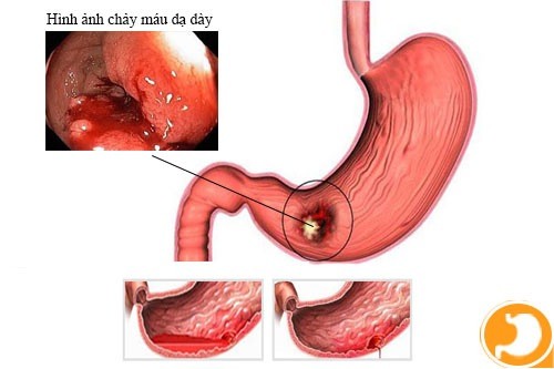 Viêm xung huyết dạ dày không được điều trị hiệu quả có thể dẫn đến tình trạng xuất huyết