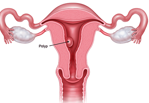 Polyp cổ tử cung là một bệnh thường gặp ở các chị em. 