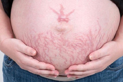 Rạn da thai kỳ là một trong những hiện tượng mà mẹ bầu thường gặp phải. 