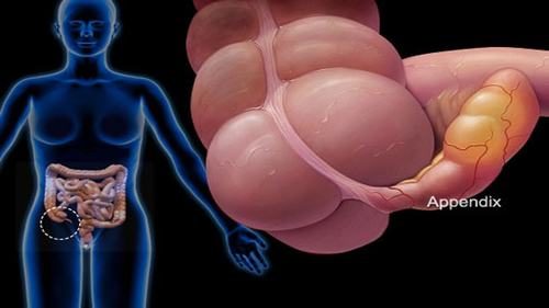 Viêm ruột thừa nếu không phát hiện và điều trị kịp thời sẽ rất nguy hiểm.