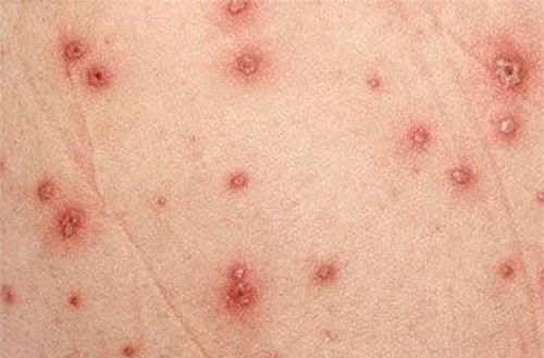 7. Giá Tiêm Ngừa Vắc Xin HPV Tại Việt Nam