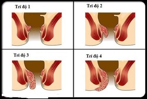 Bệnh trĩ được chia thành nhiều cấp độ, ở độ nhẹ không cần phải phẫu thuật