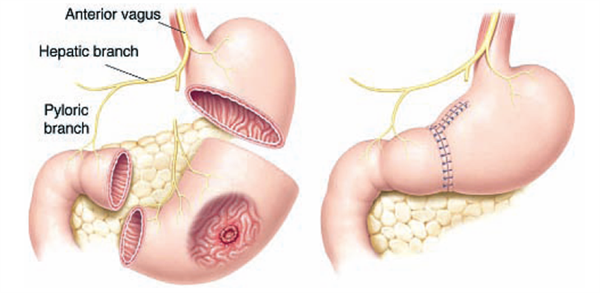 phẫu thuật ung thư dạ dày