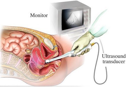 Siêu Âm Đầu Dò Có Đau Không? Tất Tần Tật Những Điều Bạn Cần Biết