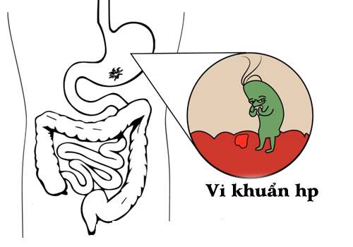 Vi khuẩn HP cư trú trong lớp niêm mạc dạ dày và gây ra các triệu chứng của các bệnh dạ dày