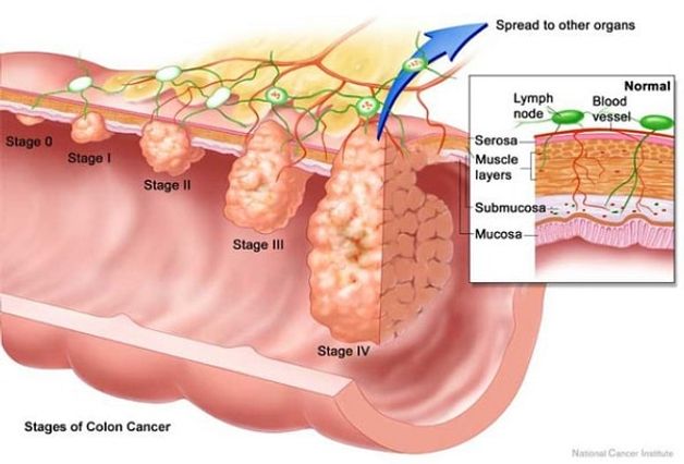 ung thư đại tràng giai đoạn 3