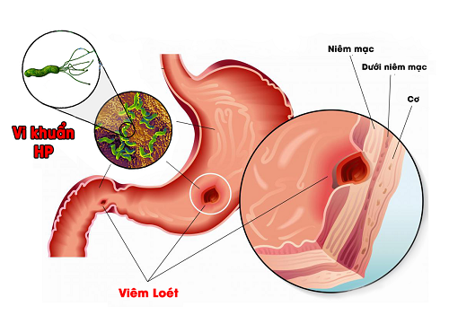 Vi khuẩn HP là nguyên nhân gây ra các bệnh ở dạ dày và làm tăng nguy cơ mắc ung thư dạ dày