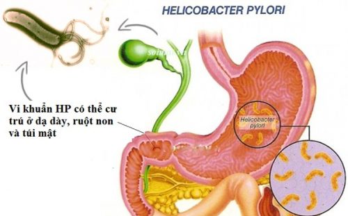 Vi khuẩn HP là loại vi khuẩn có khả năng tồn tại trong môi trường axit đậm đặc trong dạ dày gây bệnh