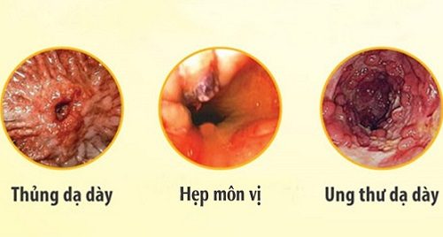 Viêm niêm mạc hang vị dạ dày là bệnh lý nguy hiểm và có thể gây nhiều biến chứng