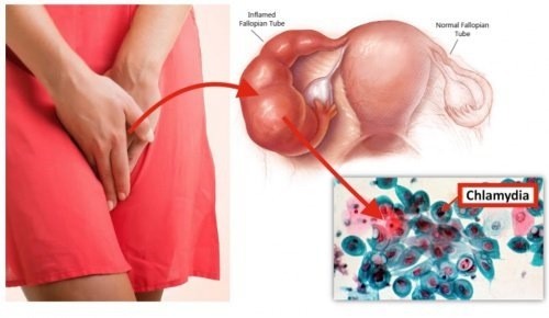 Chlamydia gây ảnh hưởng nghiêm trọng đến sức khỏe sinh sản cần được phát hiện sớm để điều trị hiệu quả