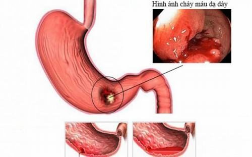 Xuất huyết dạ dày là bệnh lý nguy hiểm cần được xử trí sớm, đúng cách