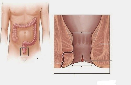 Bệnh nứt kẽ hậu môn là hậu môn xuất hiện ổ viêm loét khiến vùng nếp nhăn nếp gấp bên ngoài bị nứt ra