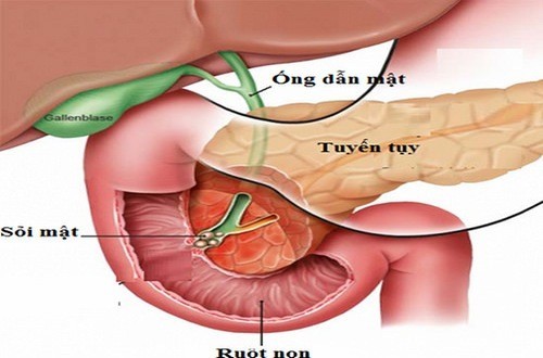 Máu nhiễm mỡ có thể gây nên bệnh viêm tụy