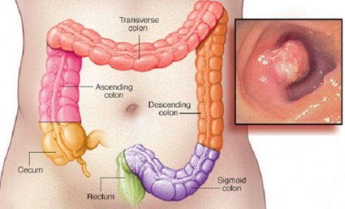 Polyp hậu môn cũng là bệnh thường xuất hiện và nguy hiểm cần được phát hiện sớm