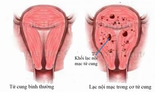 Lạc nội mạc tử cung là một bệnh thường gặp ở các chị em.