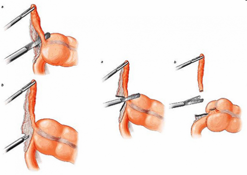 Viêm ruột thừa là bệnh nguy hiểm cần được phẫu thuật càng sớm càng tốt