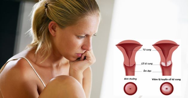 Bệnh viêm lộ tuyến cổ tử cung thường gặp ở những phụ nữ đã quan hệ tình dục hoặc đang trong độ tuổi sinh nở