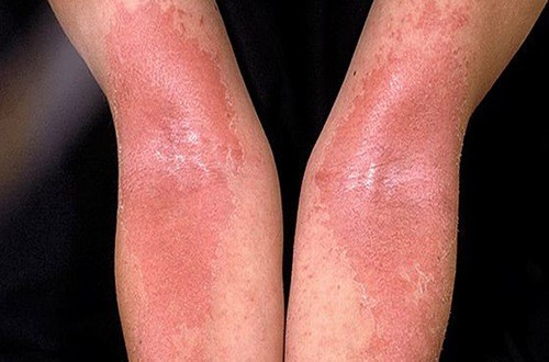 Câu hỏi thường gặp về Eczema