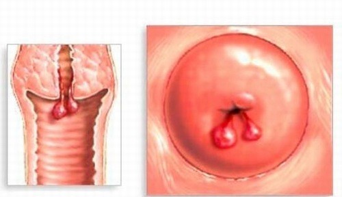 Polyp cổ tử cung hình thành do phát triển quá mức của nội mạc tử cung