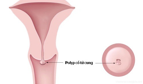 Có thể có một hoặc nhiều polyp tử cung trong cơ thể chị em.