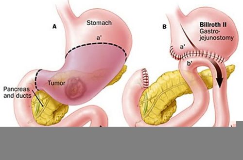 Hiện có 2 phương pháp điều trị là mổ hở và mổ nội soi cắt một phần hoặc toàn bộ dạ dày (tùy vào tình trạng bệnh của mỗi người)
