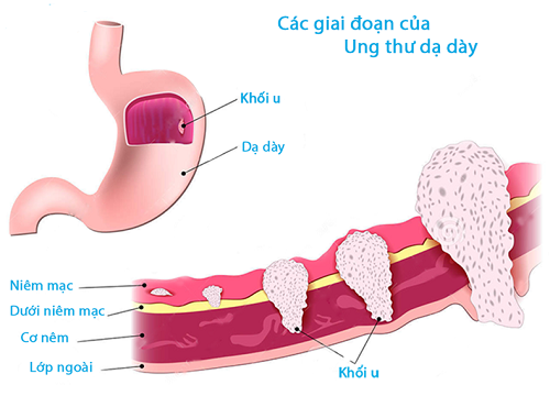 Tùy thuộc vào giai đoạn bệnh cụ thể mà có phương pháp chữa ung thư dạ dày khác nhau