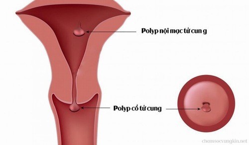 Polyp lòng tử cung có thể gây bít tắc tử cung, gây ra nhiều vấn đề ảnh hưởng đến sức khỏe người bệnh. 