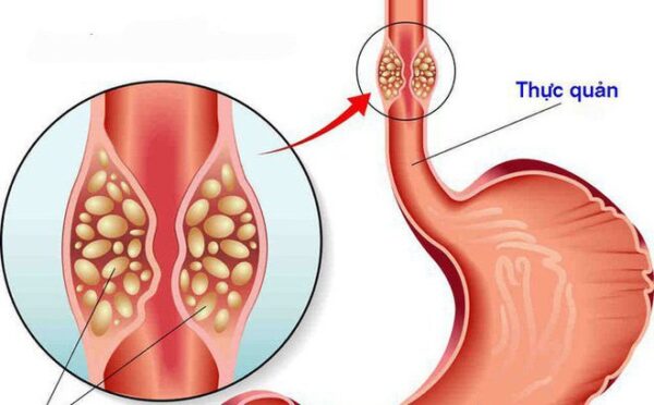 ung thư thực quản khi tiến đến di căn