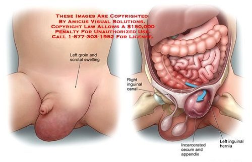 Thoát vị bẹn là bệnh nguy hiểm cần phát hiện và điều trị sớm