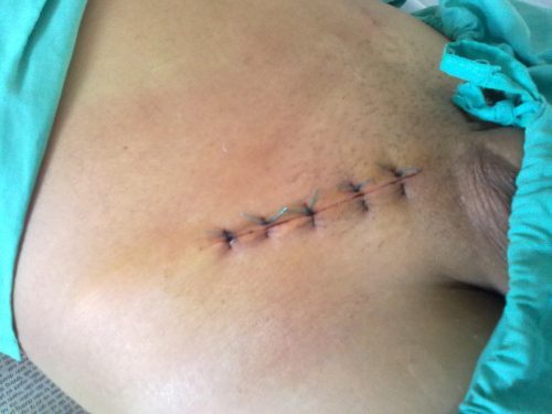 Sau mổ thoát vị bẹn người bệnh có thể gặp phải một số biến chứng không mong muốn