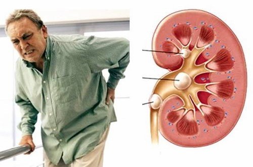 Sỏi thận nếu không được chữa trị hiệu quả có thể gây nên biến chứng nguy hiểm