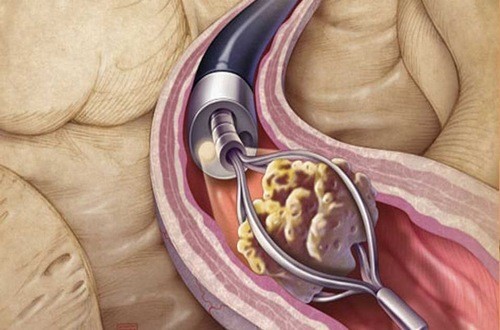 Sỏi thận cần được điều trị hiệu quả
