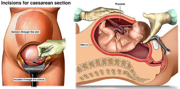 Ca sinh mổ mất bao lâu và diễn ra thế nào, đây là quan tâm của nhiều mẹ sinh con lần đầu.
