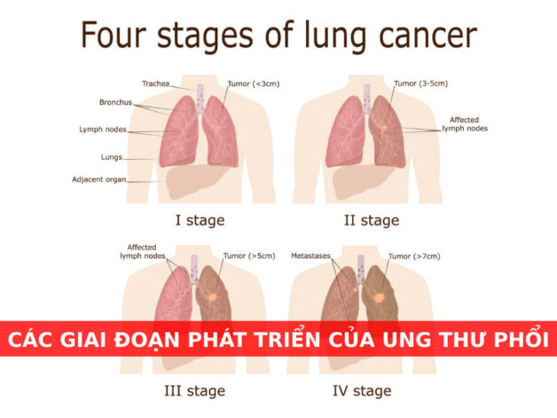 dấu hiệu ung thư phổi giai đoạn 2