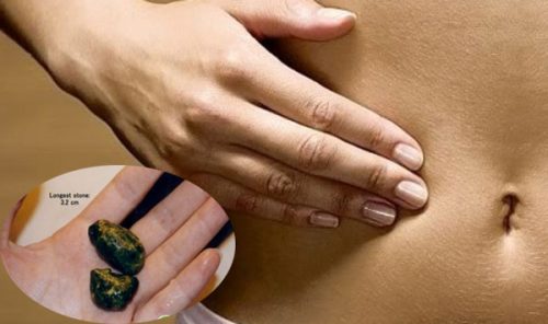 Người bệnh cũng có thể gặp phải tình trạng đau bụng do sỏi mật