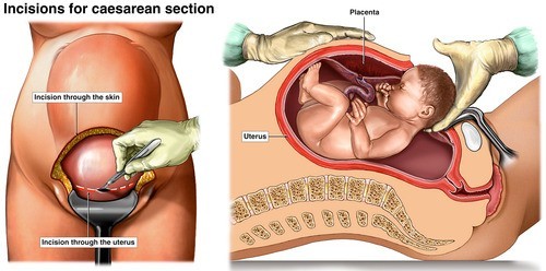 So sánh giữa sinh mổ và sinh thường