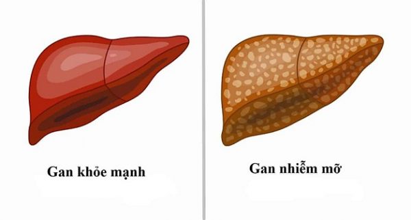 Gan nhiễm mỡ nhẹ là hiện tượng lượng mỡ có trong gan chiếm 5 – 10% tổng trọng lượng lá gan.