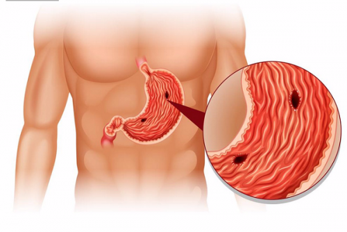 Thủng dạ dày là một trong những hậu quả của bệnh viêm loét dạ dày tá tràng