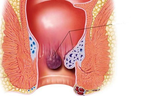 Cắt polyp hậu môn thường được chỉ định trong những trường hợp bệnh nặng, polyp có kích thước lớn