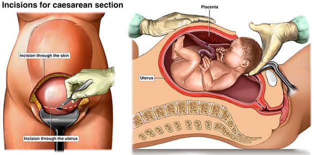 Với phương pháp sinh mổ, em bé chào đời không qua đường âm đạo như thông thường mà ra khỏi tử cung của người mẹ