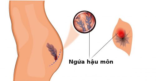 Ngứa hậu môn do nhiều nguyên nhân khác nhau gây ra khiến người bệnh khó chịu
