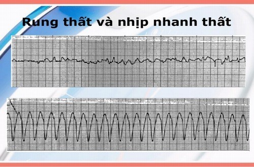 Rung thất cần được phát hiện sớm và điều trị hiệu quả