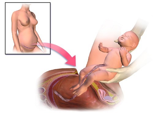 4. Những lưu ý về sinh hoạt sau sinh mổ