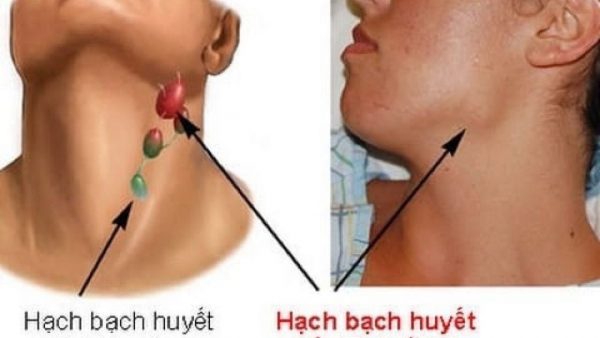 Triệu chứng ung thư hạch bạch huyết