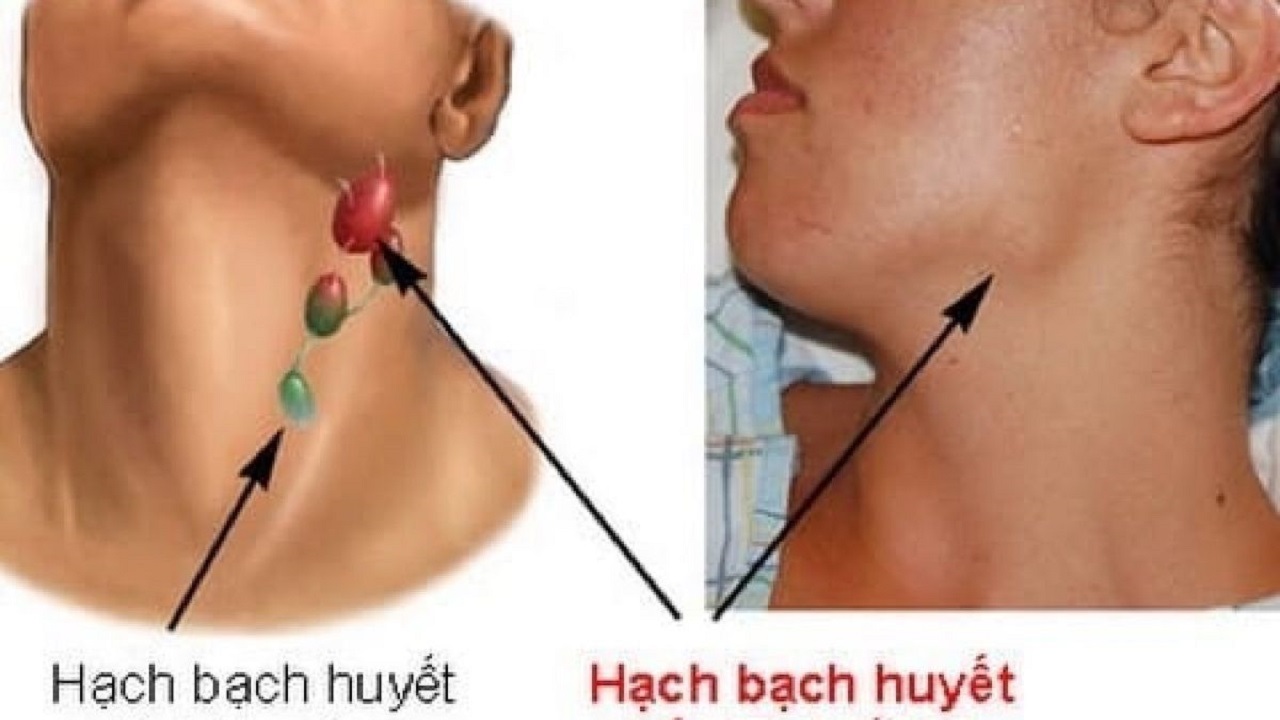 HẠCH DƯỚI HÀM NỔI TO CÓ THỂ LÀ DẤU HIỆU BỆNH LÝ NGHIÊM TRỌNG
