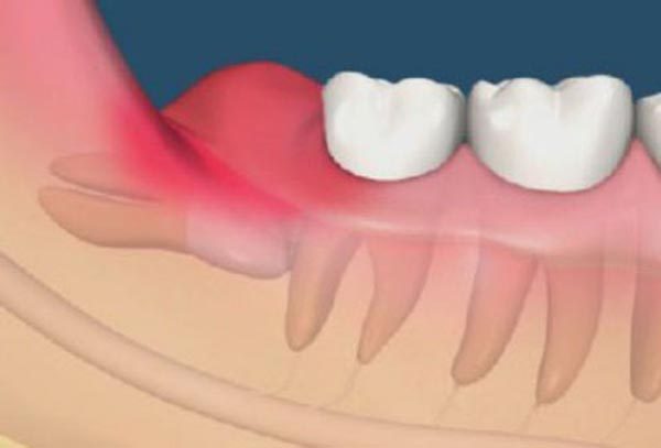 Khi bị tiểu đường, lợi (nướu) sẽ là nơi nhận ảnh hưởng nhiều nhất.
