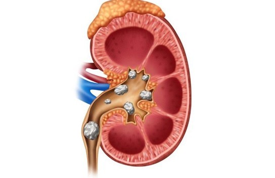 Khi bị bệnh sỏi thận và sỏi đường tiết niệu, người bệnh sẽ thấy đái khó, đái buốt, đái rắt, màu sắc nước tiểu thay đổi (đục, đỏ…)